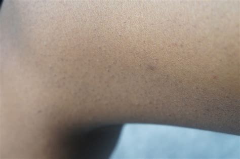 HOW I MANAGE MY KERATOSIS PILARIS | The-plug