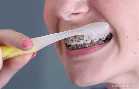 Brushing Flossing and Braces | Dentistry & Orthodontics