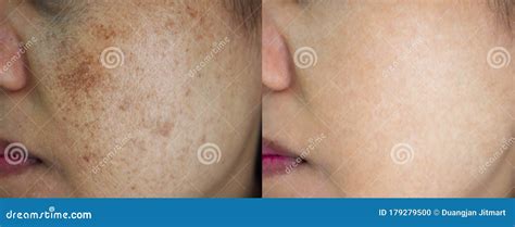 Before And After Spot Melasma Treatment Stock Photography ...