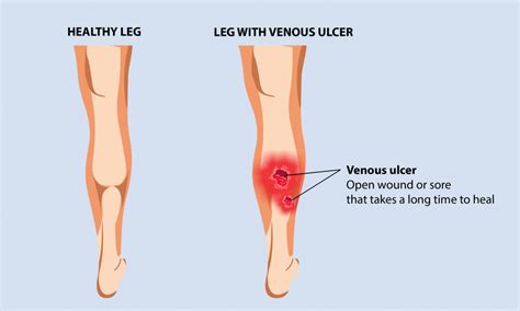 Venous Leg Ulcer: Symptoms, Causes, and Prevention