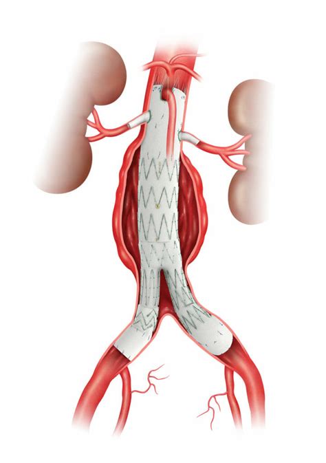 Abdominal Aortic Aneurysm (AAA) - Vascular Care WA