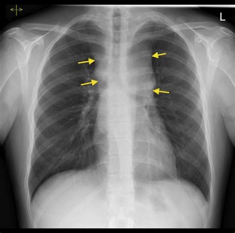 Anterior mediastinal mass - Radiology at St. Vincent's University Hospital