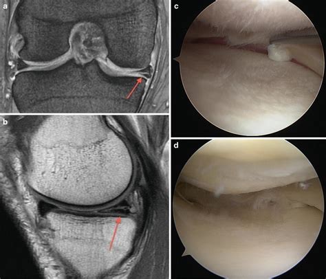 Meniscus Tear MRI Correlation | Radiology Key