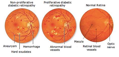 Moderate Diabetic Retinopathy