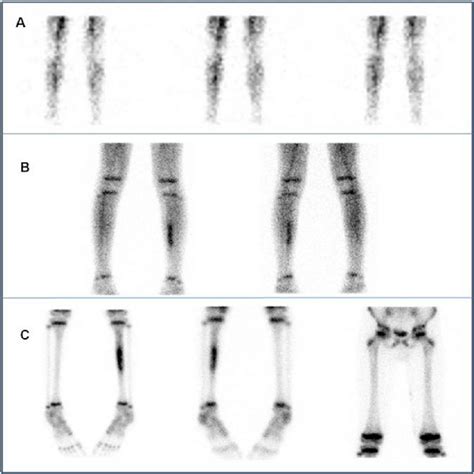 Three-phase bone scan from the legs: Upper row(A): anterior images of ...