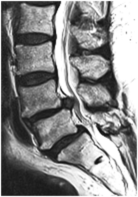 Herniated Disc Thoracic Mri