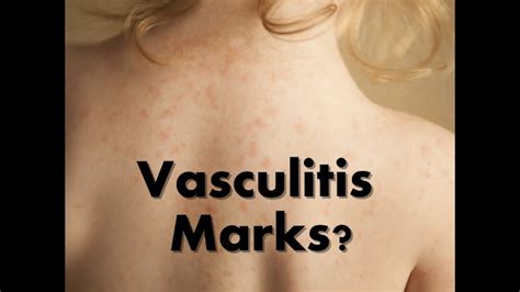 Vasculitis Treatment