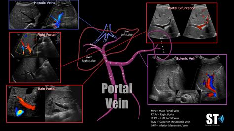 Portal Vein Doppler – Sonographic Tendencies