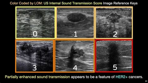 US Features of Solid Breast Masses as Prognostic Biomarkers - YouTube