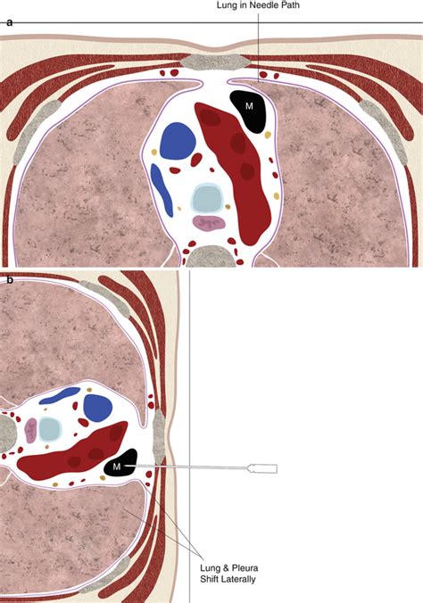 Biopsy of Mediastinal Lesions | Radiology Key