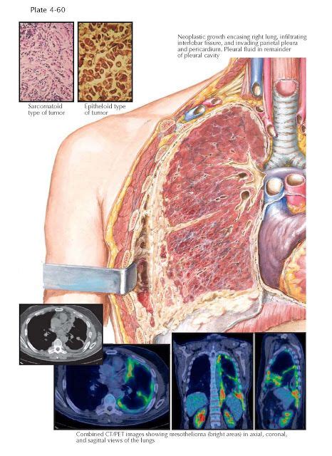 MALIGNANT PLEURAL MESOTHELIOMA | Mesothelioma, Respiratory system ...