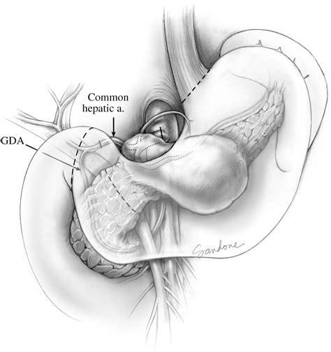 Figure 1 from Resection of the celiac axis for invasive pancreatic ...