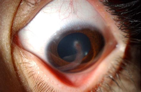 Resolution of childhood recurrent corneal phlyctenulosis following ...