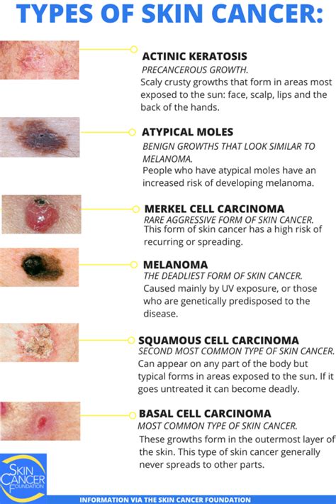 Skin Cancer Types | Basal Cell Carcinoma (BCC) | Squamous Cell ...