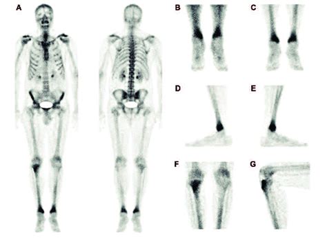 Whole body bone scan (panel A), blood pool (B) and bone phase views of ...