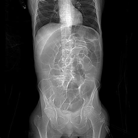 Perspectives on paralytic ileus - Weledji - 2020 - Acute Medicine ...