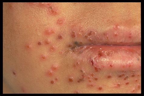 Eczema Herpeticum- A Rare Problem of Atopic Dermatitis. When eczema ...