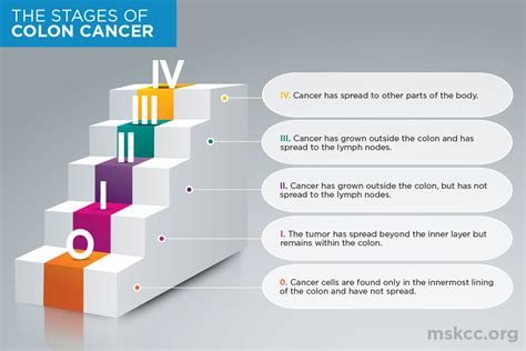 Colon Cancer Stages 0, 1, 2, 3, 4 | Memorial Sloan Kettering Cancer Center