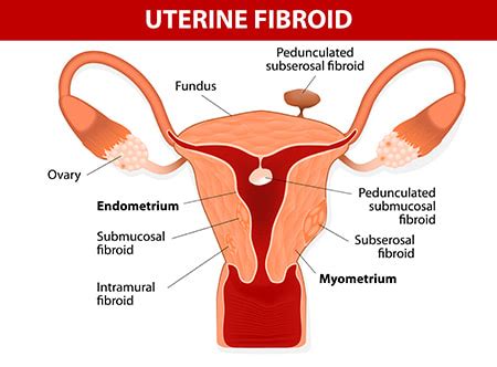 Surgery Day: Full Thickness Fibroid Tumor - MISSOURI FERTILITY