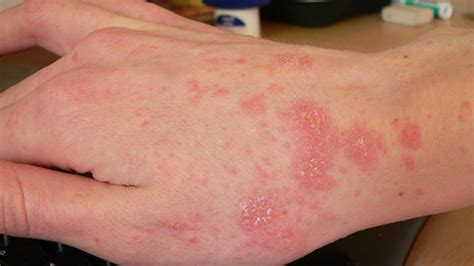 Scabies Bites: Pictures, Symptoms, and Treatments