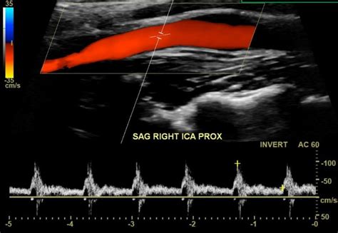 Carotid bruit: What is it? What causes it? Will I have a stroke?