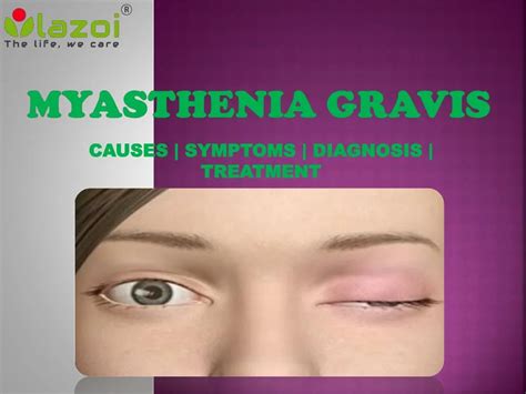 PPT - Myasthenia Gravis: Symptoms, Causes, diagnosis and treatment ...