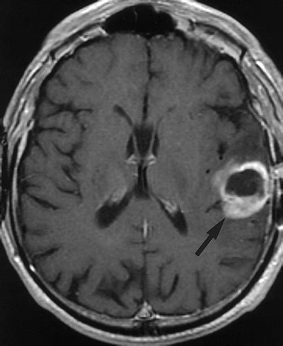 Cat Scan Brain Tumor