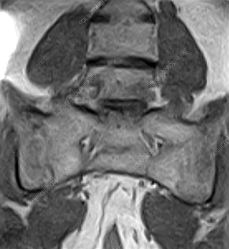 Ankylosing Spondylitis Mri Si Joints