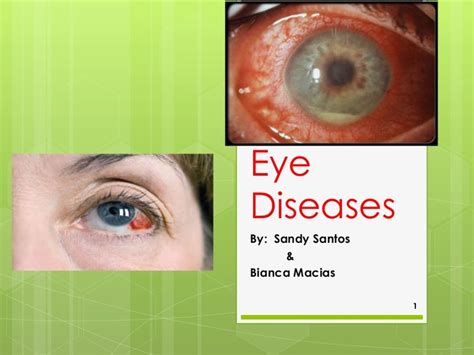 Eye diseases