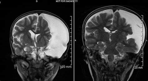 Case study: Shunt relieves pressure from arachnoid brain cyst, allowing ...