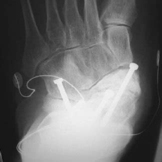 (PDF) Triple Arthrodesis