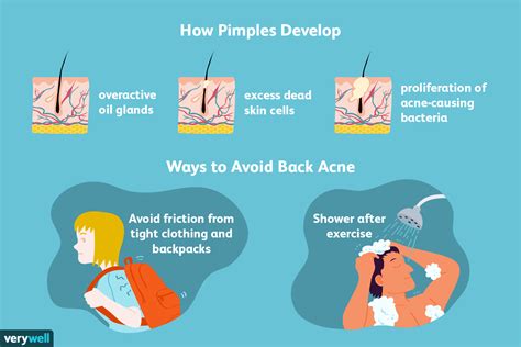 Body and Back Acne Basics, Causes, and Treatment