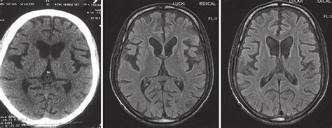 (a) Computed tomography scan of brain showing cerebral atrophy and ...