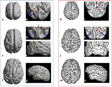 Lissencephaly