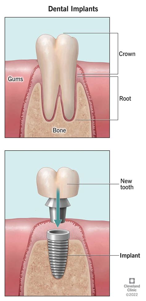 Dental Implants: Procedure, Purpose & Benefits