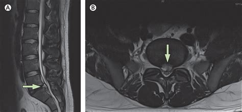 Herniated Disc Thoracic Mri