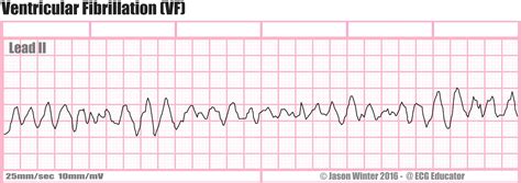 ECG Educator Blog : Ventricular Rhythms