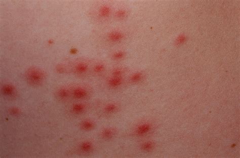 Folliculitis - Causes, Signs, Symptoms, How to Get Rid of Folliculitis