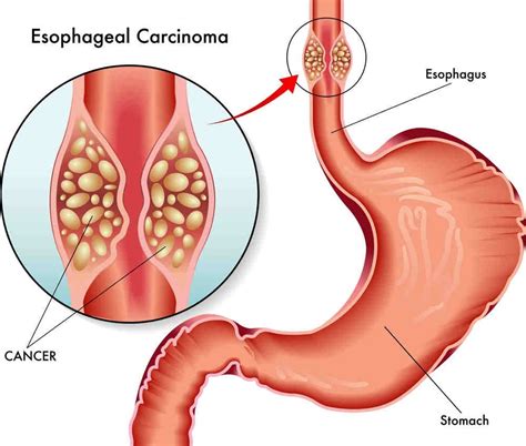 Heal Barrett's Esophagus Conventionally and Non-Conventionally