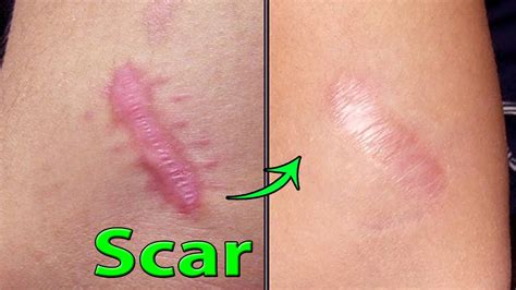 6 AMAZING NATURAL SCAR REMEDIES | Natural Life - YouTube