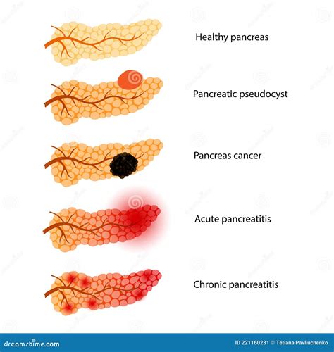 Acute Pancreatitis Cartoon