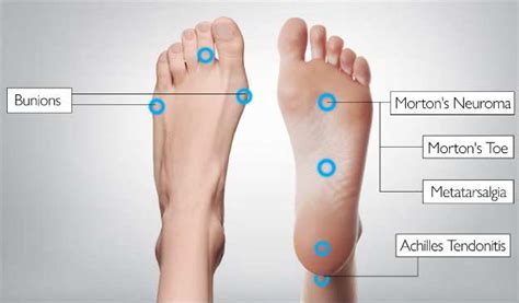 Causes Of Foot Pain Chart