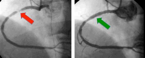 Coronary Angiography +/- Angioplasty and Stenting - United Cardiology