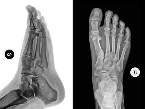 The Most Common Types of Ankle Fractures | Simon Moyes