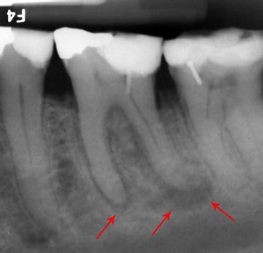 Abscessed_tooth_periapical_radiograph – Ace Achievers