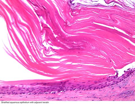 Pathology Outlines - Teratoma-epidermoid cyst