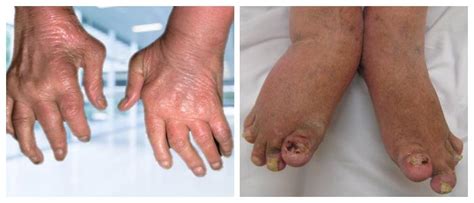 What is Psoriatic Arthritis? Definition, Symptoms and Treatment - Hoool ...