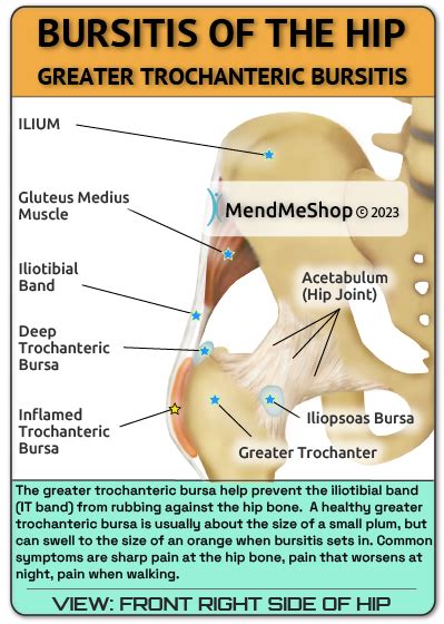 Trochanteric Hip Bursitis: Symptoms Causes Diagnosis Treatment