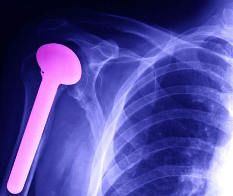 Shoulder Arthritis Surgery