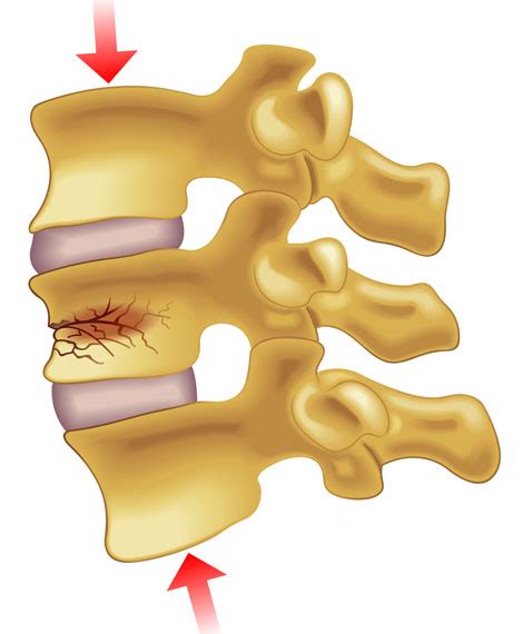 Compression Fracture Lumbar